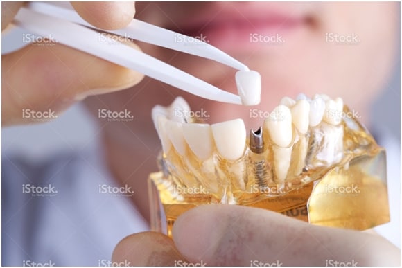 who-invented-dental-implants-dental-implants-clinic