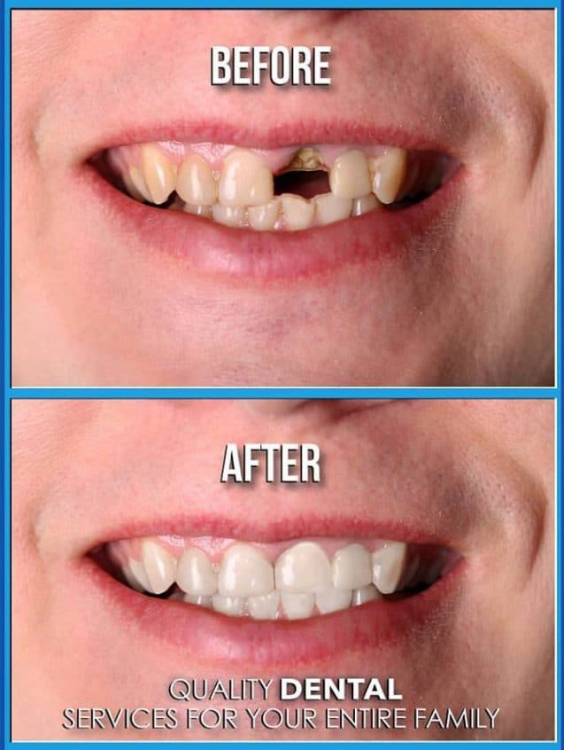 Dental Implants Pictures Before And After Photos Of Dental Implants 