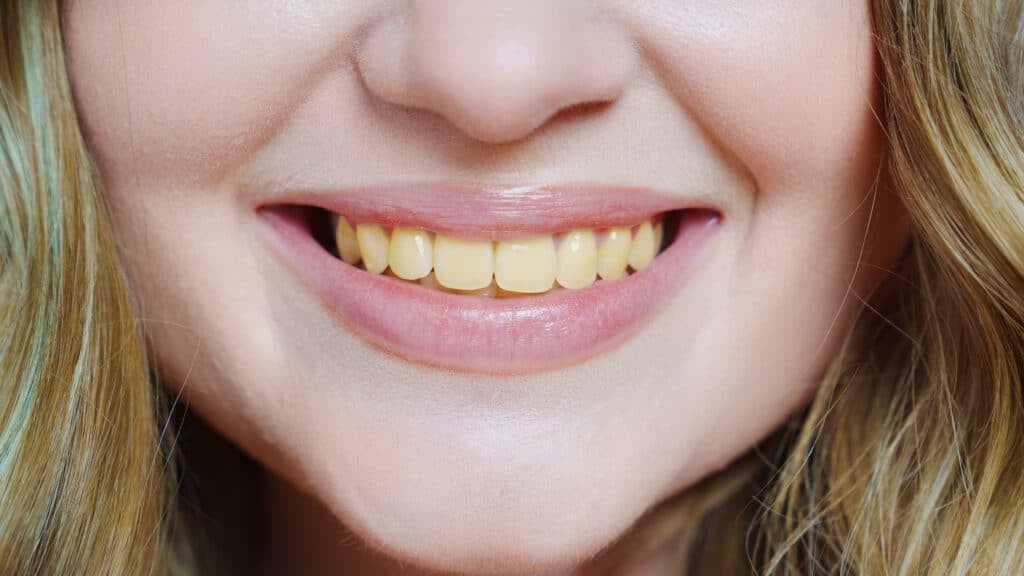 Top 10 Things You Should Know About Yellow Teeth