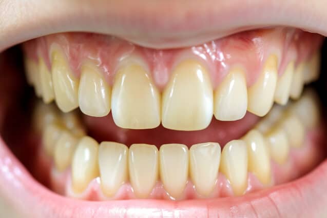 Top 10 Things You Should Know About Yellow Teeth